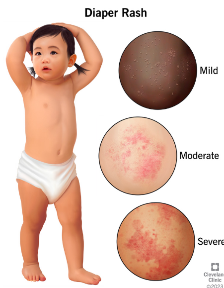 NAPPY HEAL CREAM