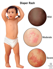 NAPPY HEAL CREAM